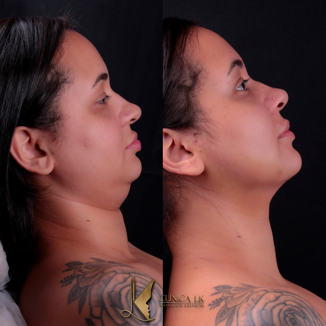 Papada 3-